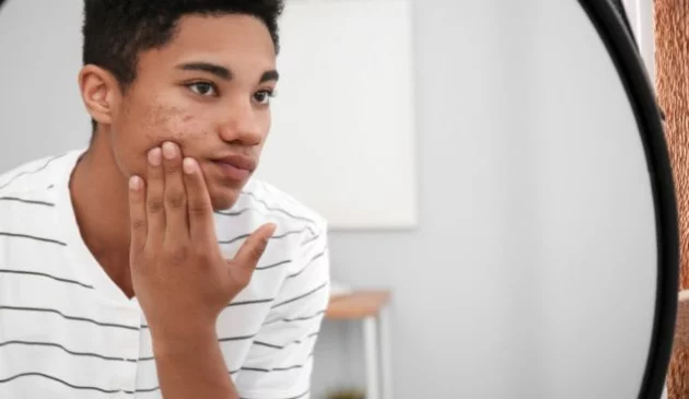 Teenage acne myths, busted