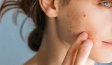 Teenage acne, spots and blemishes