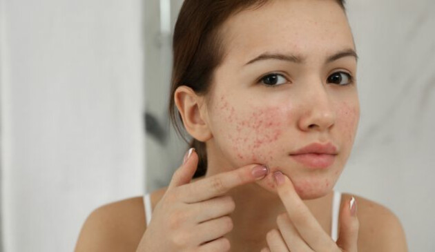 Teenage acne myths, busted