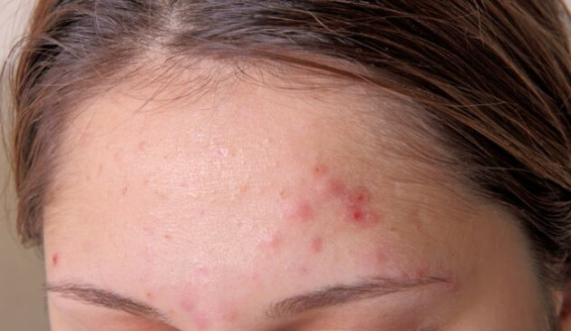 Teenage acne myths, busted