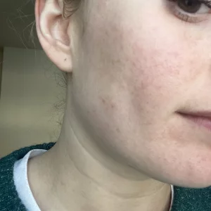 The before view of the CurrentBody LED Red Light Therapy Face Mask: Series 2