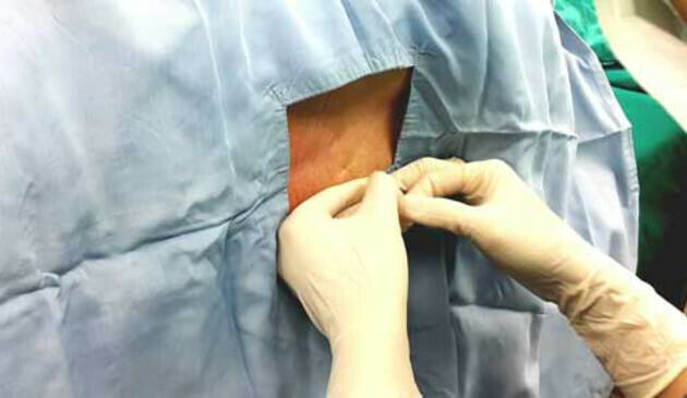 Person having an epidural