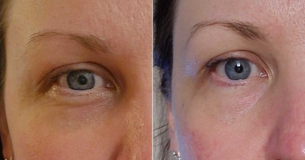 Mumsnet tester Nicola shows a before and after of her skin from using the MYKI Beauty mask
