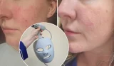 A side by side comparison of Rebecca's face after using the Shark Cryoglow LED face mask, pictured in a circle