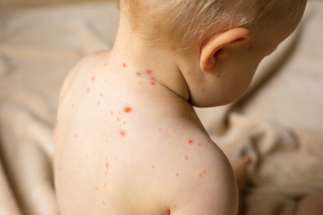 Young child's back showing chickenpox rash with red spots and blisters on pale skin requiring medical care