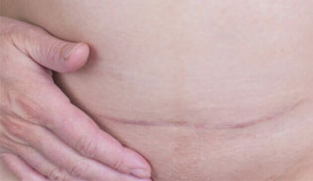 C section scar