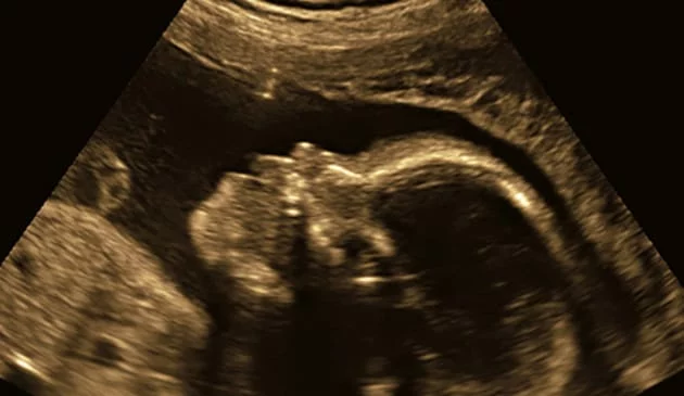 Ultrasound of a baby